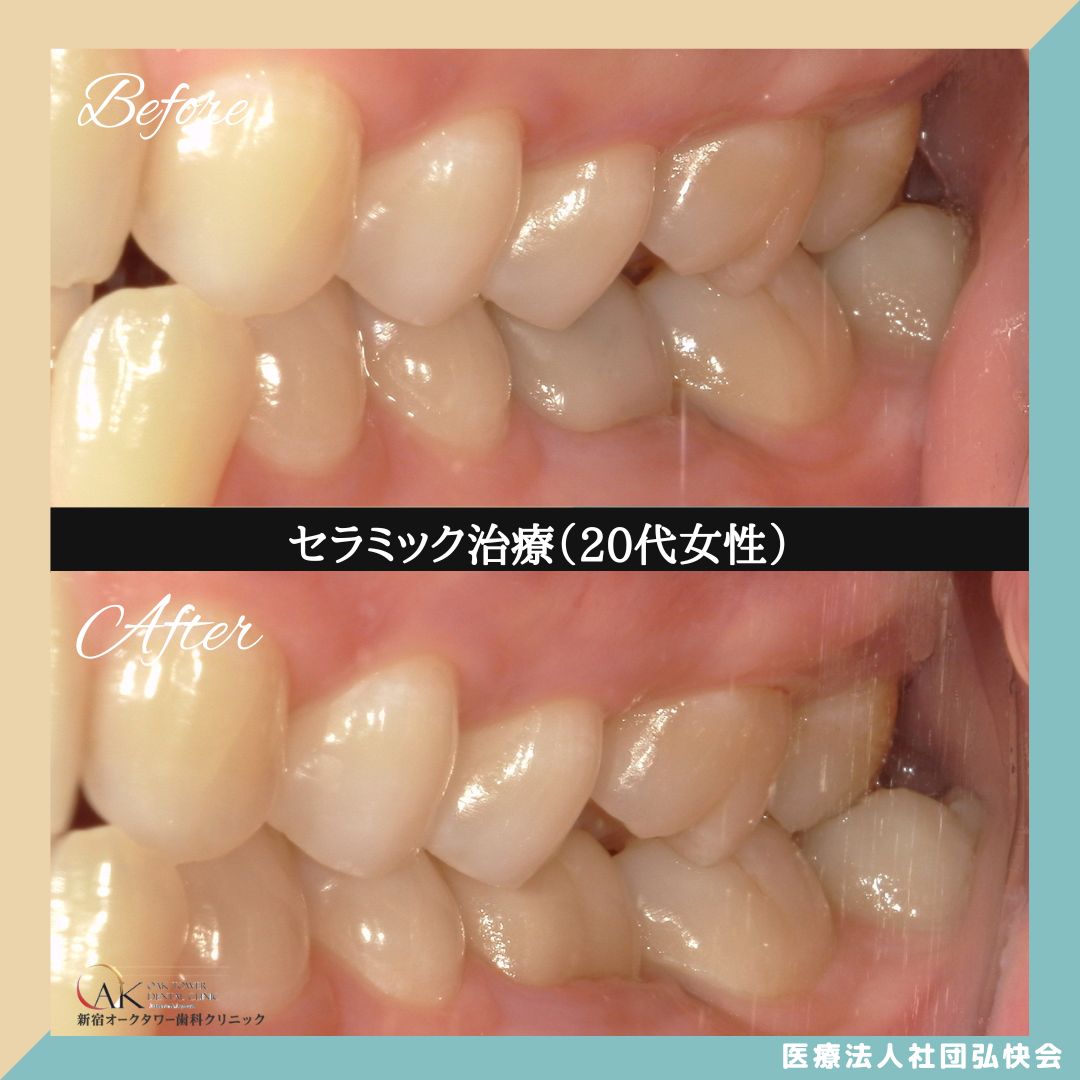 症例のご紹介68:セラミック治療(20代女性)