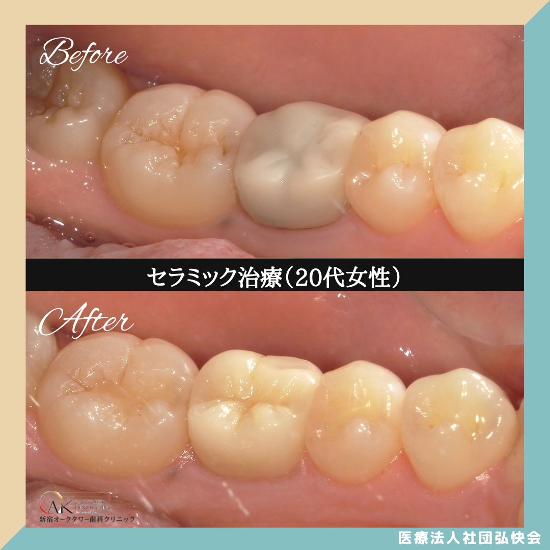 症例のご紹介68:セラミック治療(20代女性)