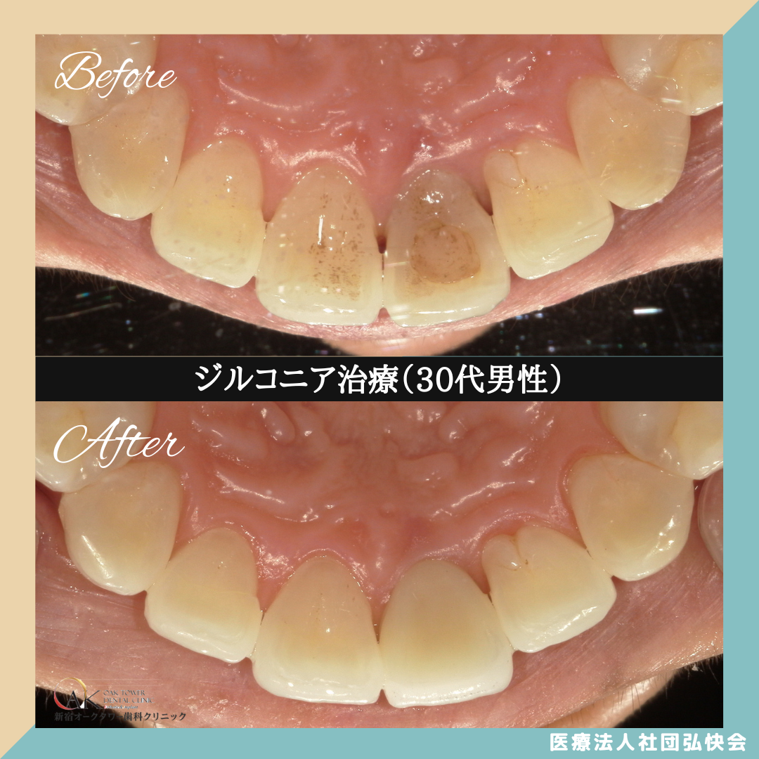 症例のご紹介75：ジルコニア治療（30代男性）