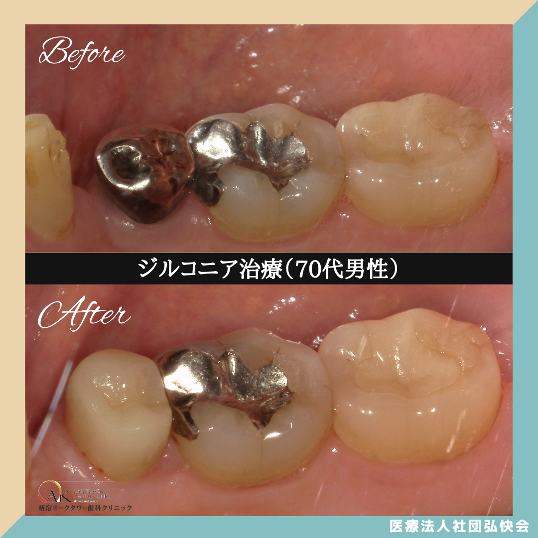 症例のご紹介79：ジルコニア治療（70代男性）