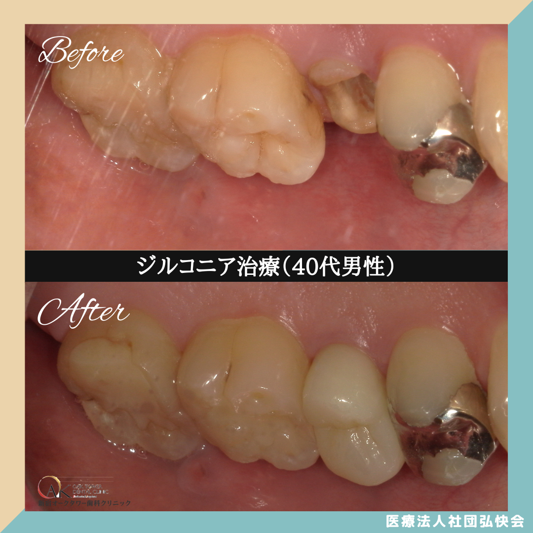 症例のご紹介84：ジルコニア治療（40代男性）