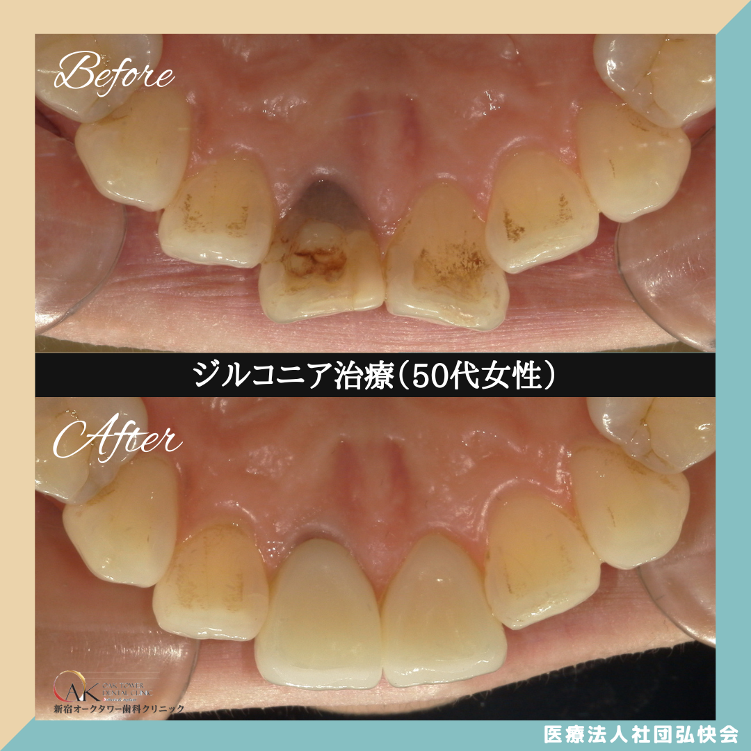症例のご紹介89：ジルコニア治療（50代女性）