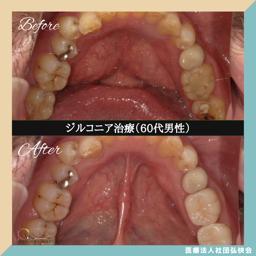 症例のご紹介121：ジルコニア治療（60代男性）