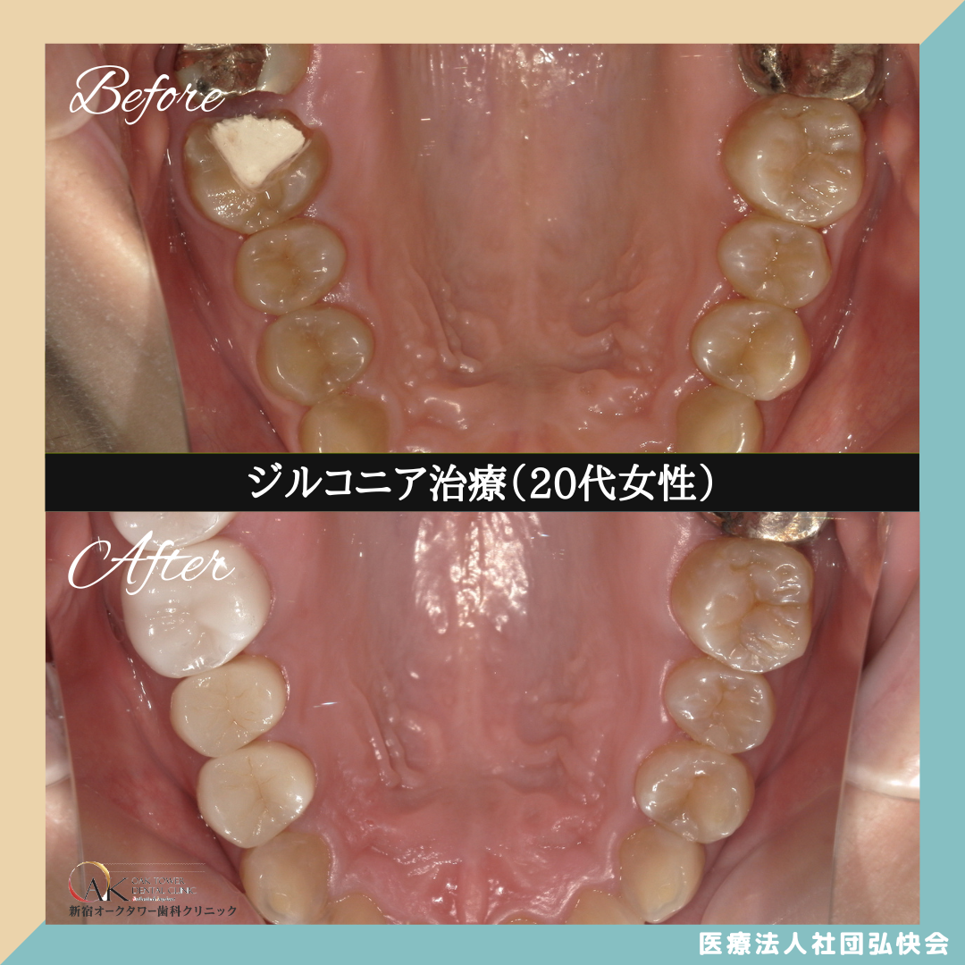 症例のご紹介122：ジルコニア治療（20代女性）