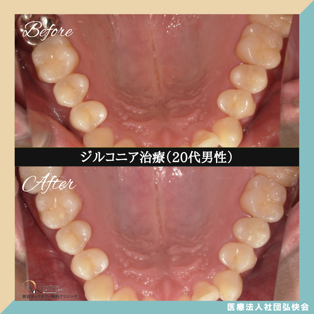 症例のご紹介126：ジルコニア治療（20代男性）
