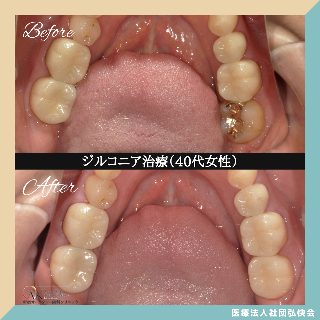 症例のご紹介128：ジルコニア治療（40代女性）