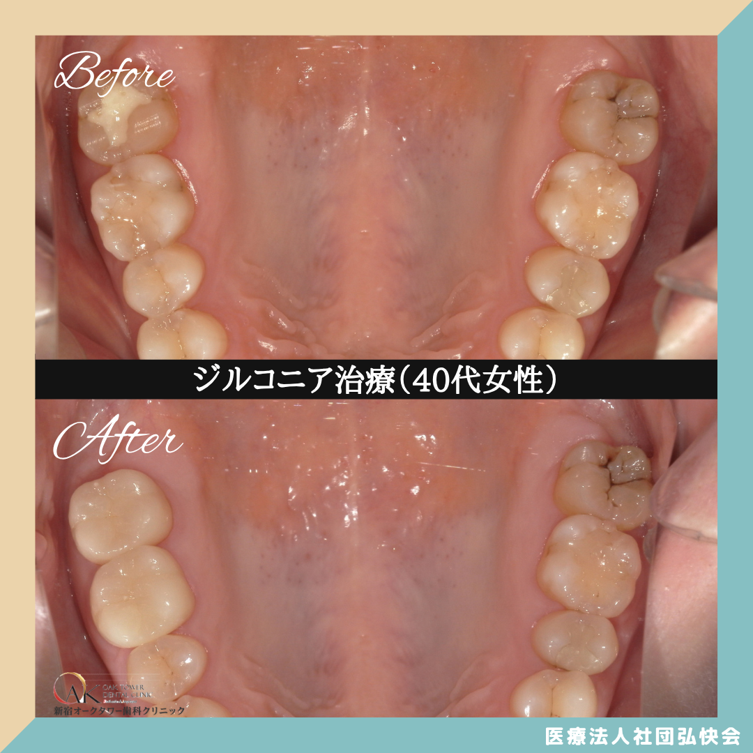 症例のご紹介130：ジルコニア治療（40代女性）